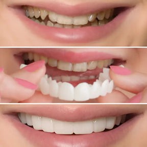 Faceta Dentária - WhitePremium® + BRINDE